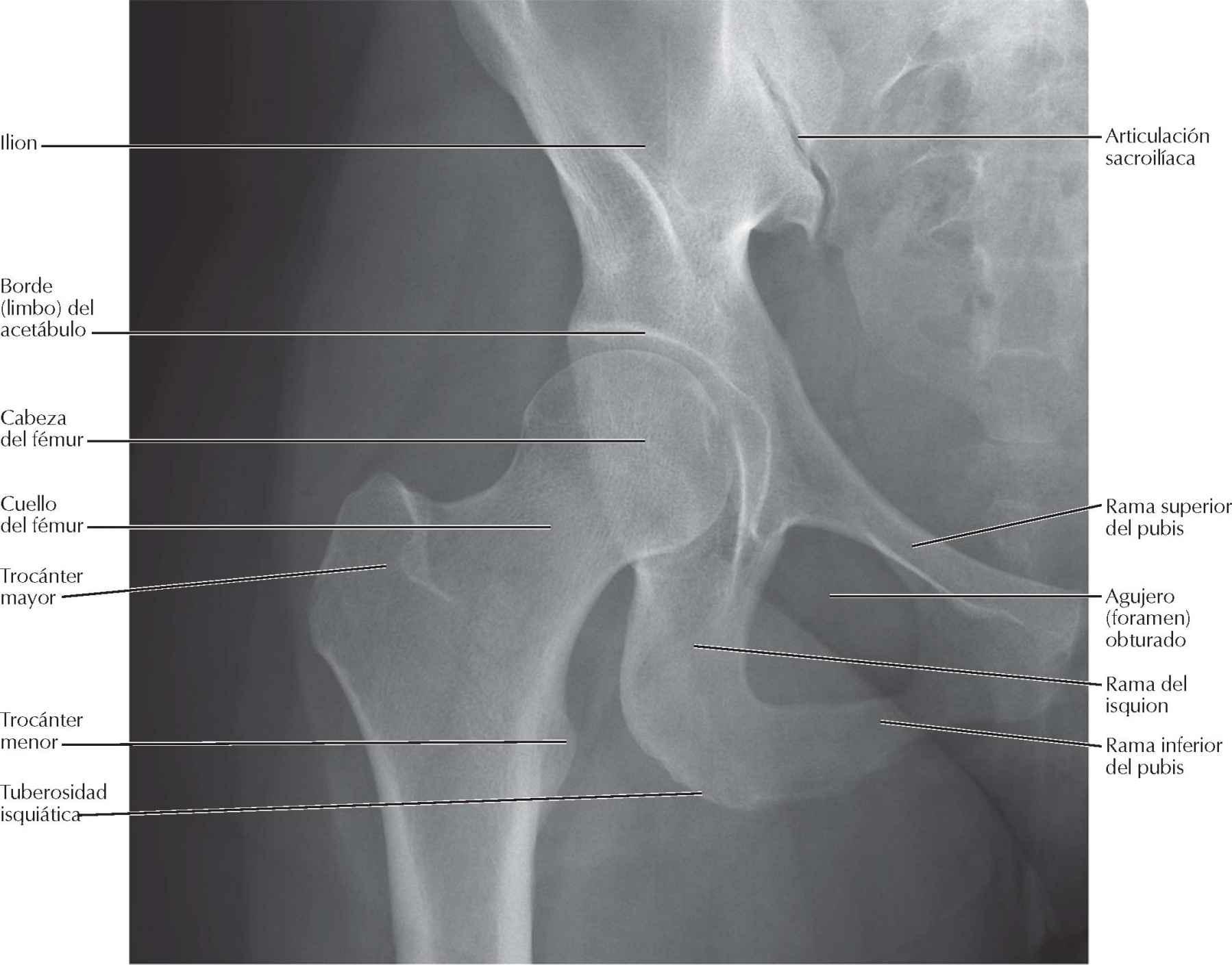 Articulación de la cadera: radiografía anteroposterior