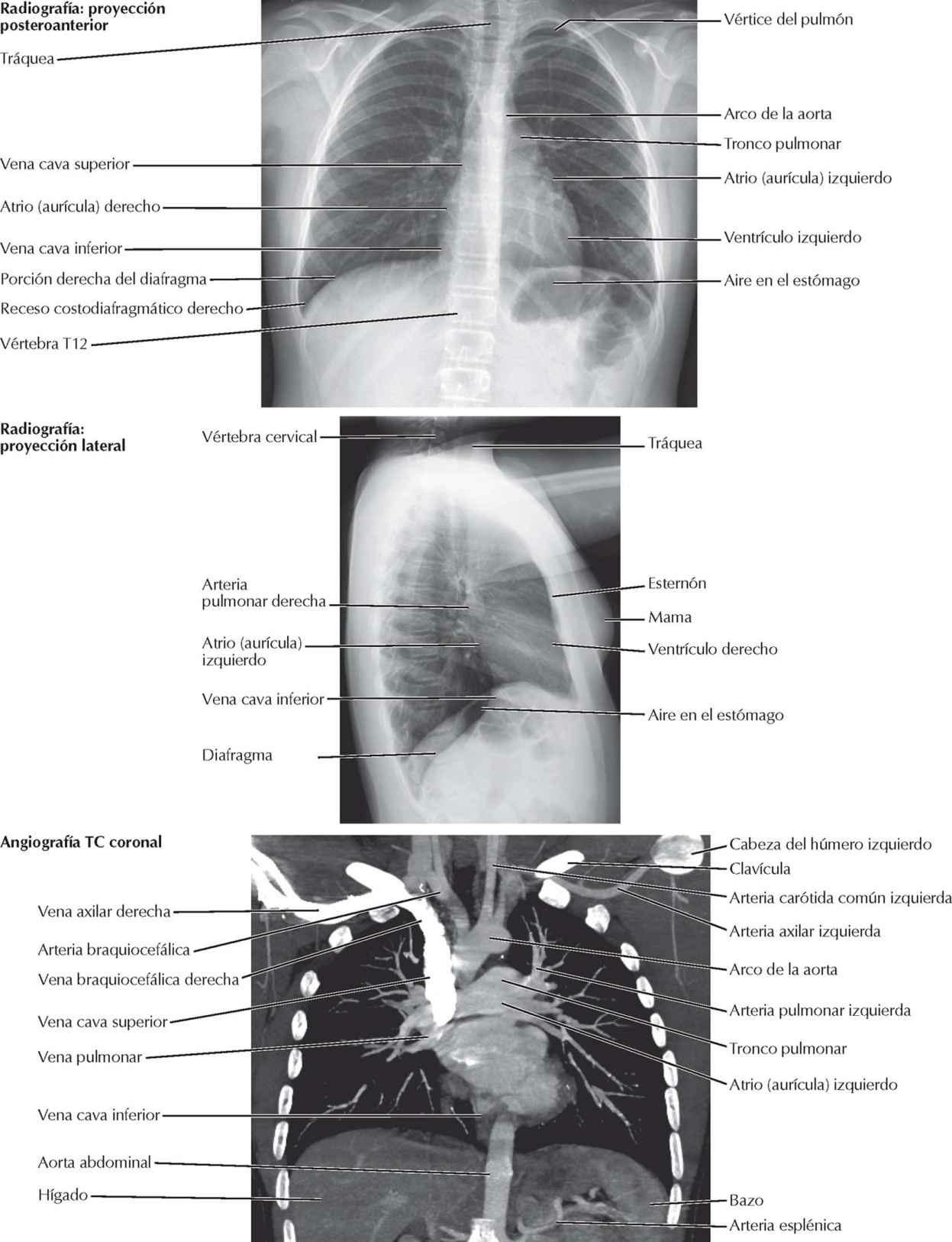 Corazón: radiografías y angiografía TC; auscultación del corazón