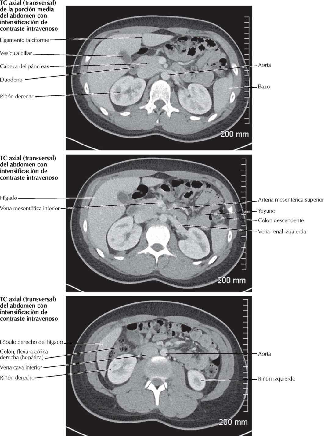 TC axiales (transversales) del abdomen (y 2)