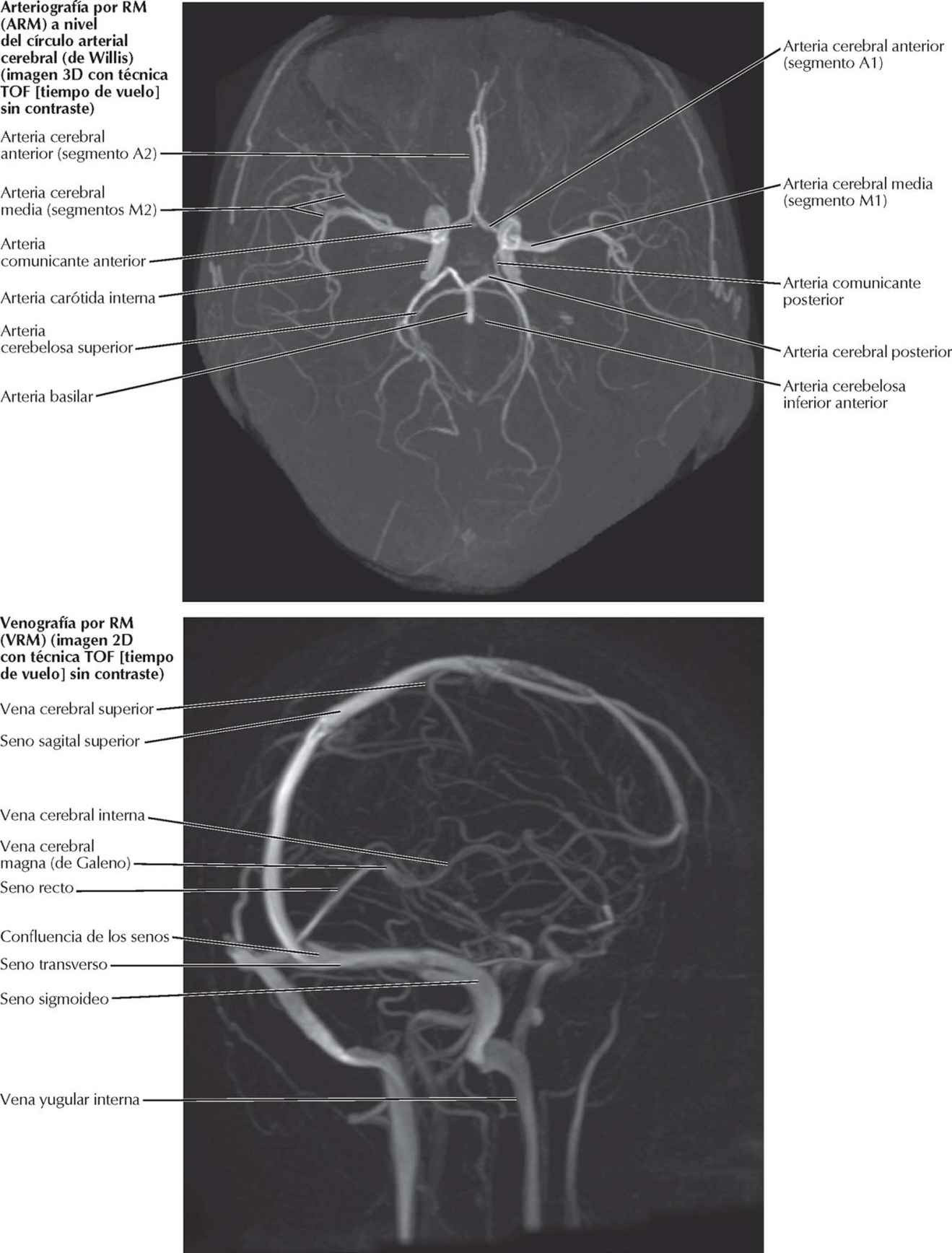 Angiografías por RM craneales (ARM y
VRM).