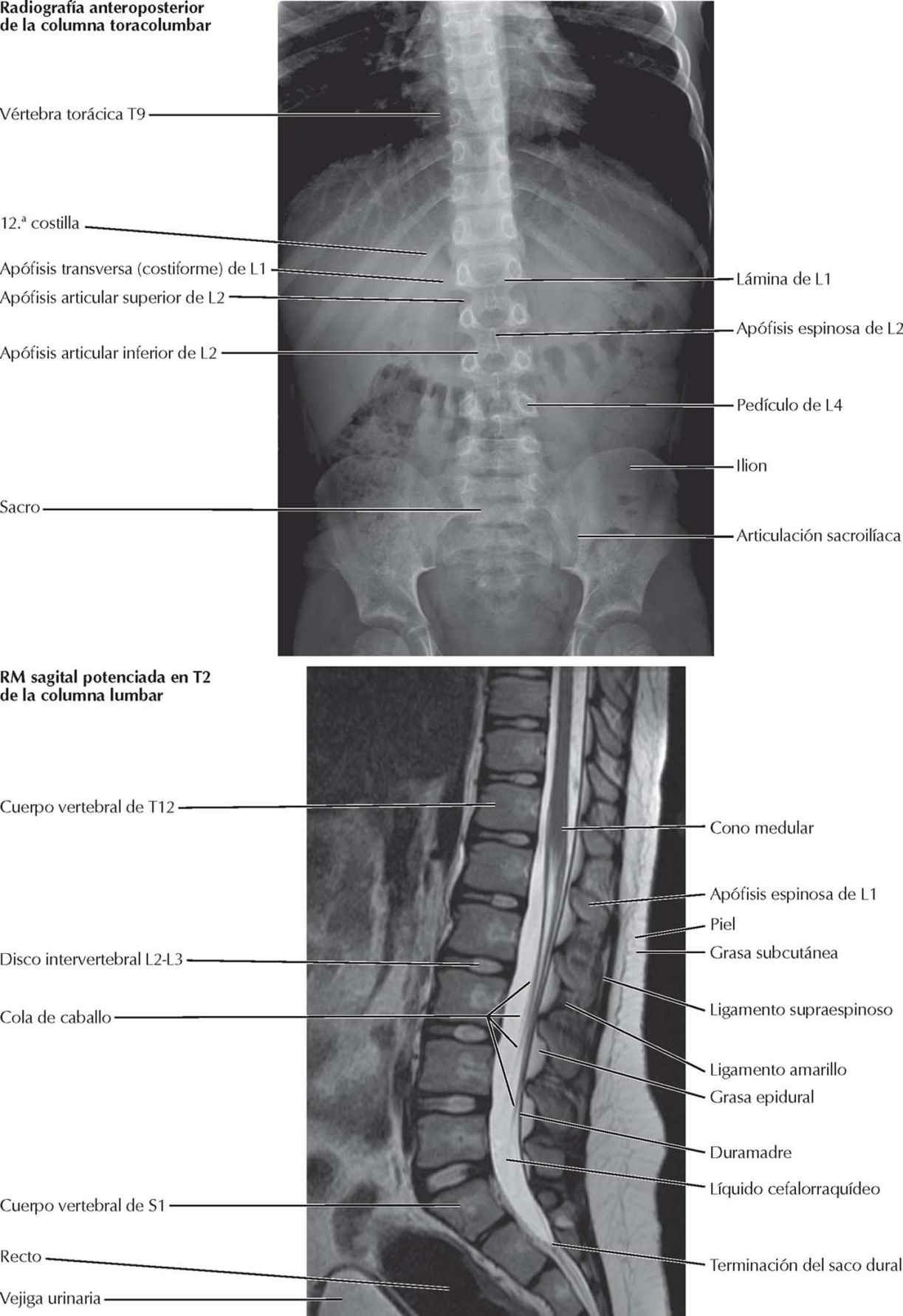 Vértebras: radiografía y RM