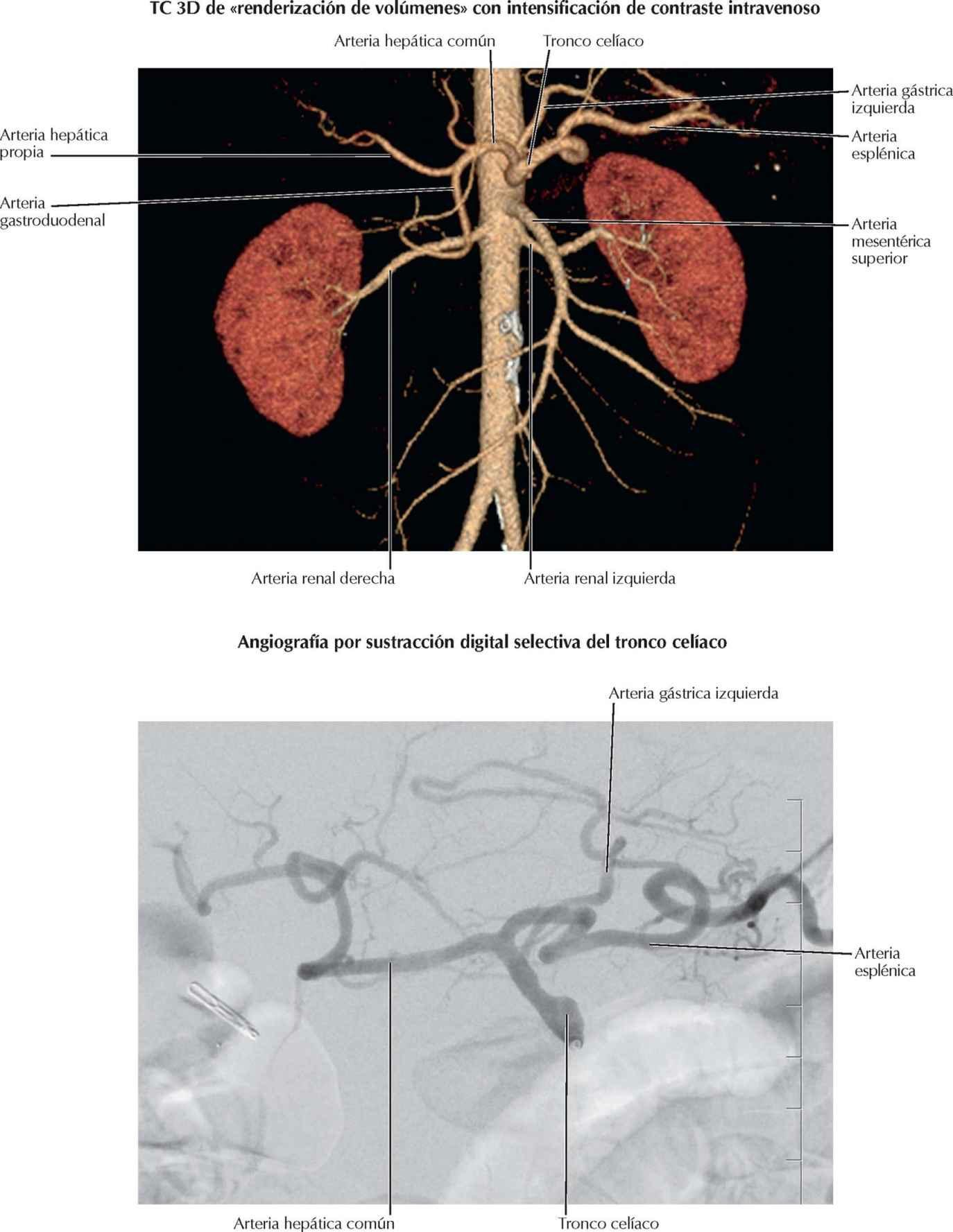 Arteriografía y angiografía por TC celíacas